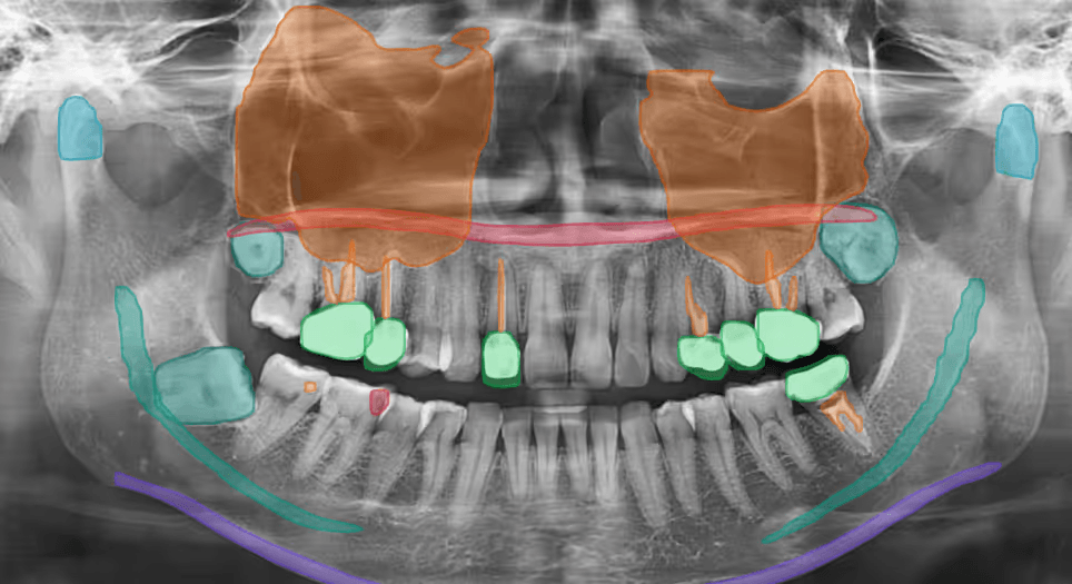 Analyse IA d'une radiographie panoramique dentaire par Orelia, zones d'intérêt clinique mises en évidence.